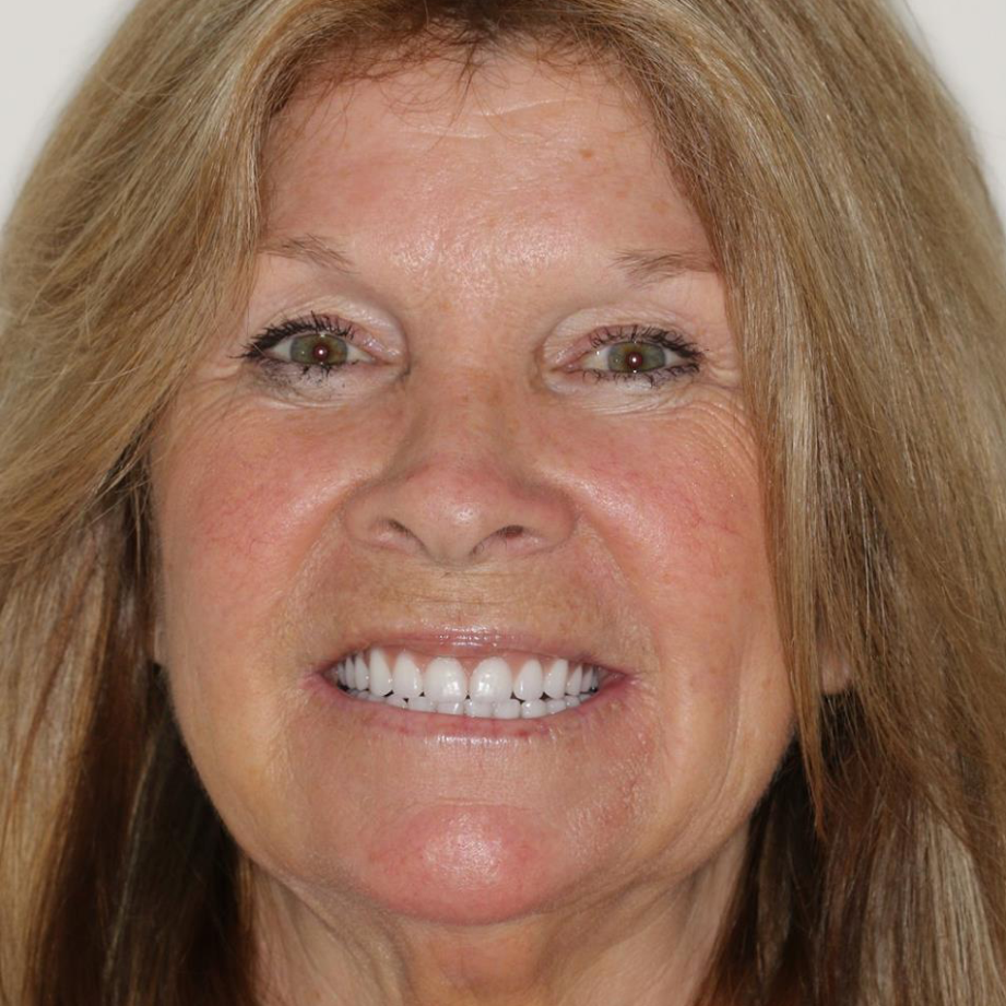 After Teeth whitening transformation 1