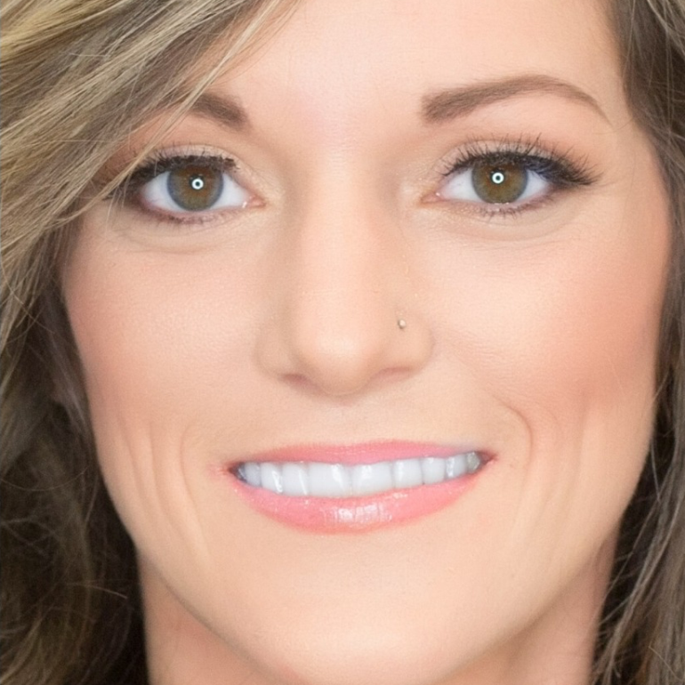 After Teeth whitening transformation 2