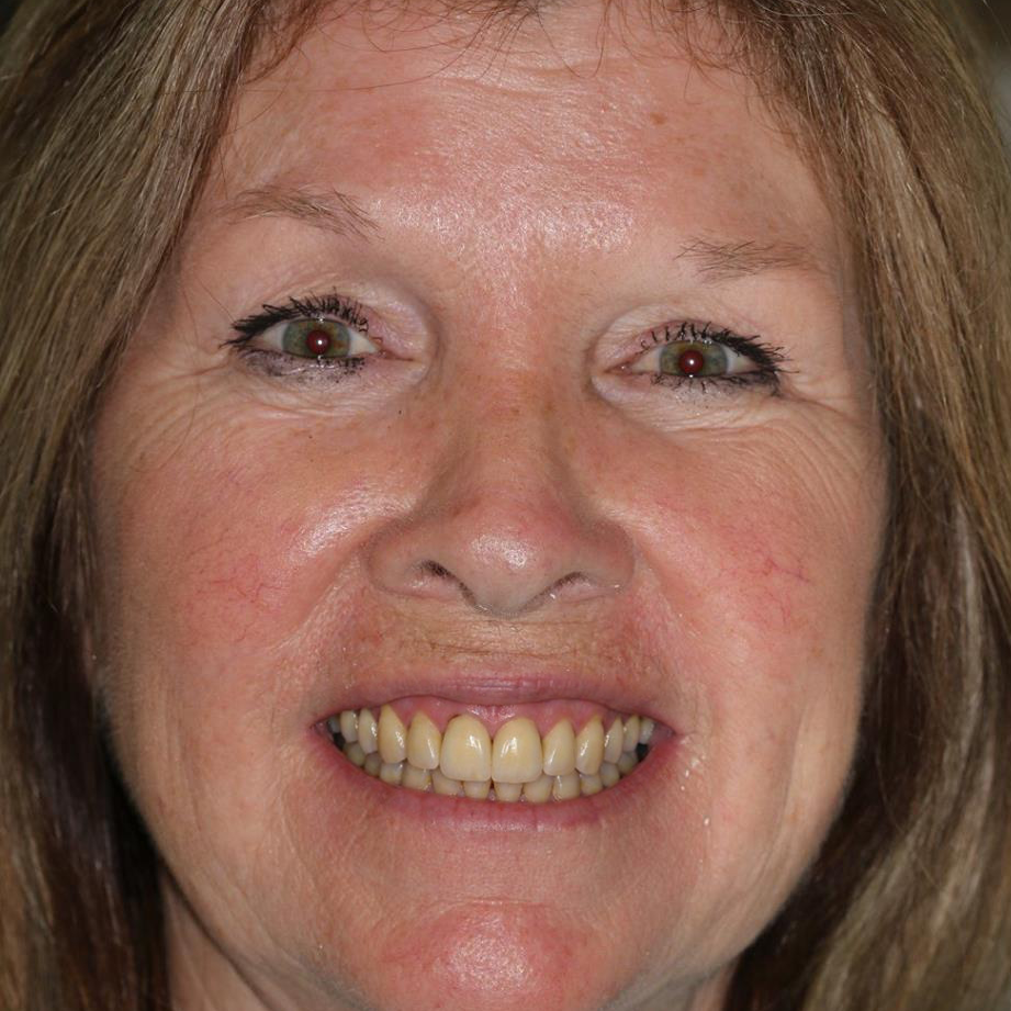 Before Teeth whitening transformation 1