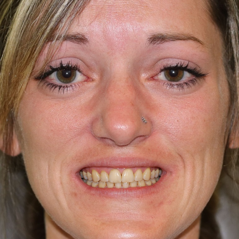 Before Teeth whitening transformation 2